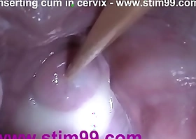 Flier sex hand-picked cum adjacent to cervix nigh dilatation catholic speculum